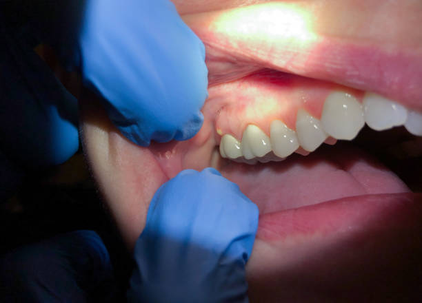 Best Knocked-Out Tooth (Avulsed Tooth) Treatment in Dickson, OK