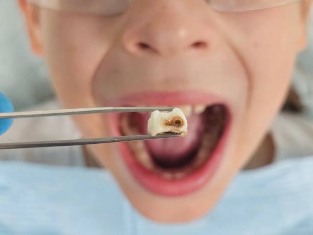 Best Broken or Chipped Tooth Repair in Dickson, OK